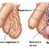 VARICOCELE