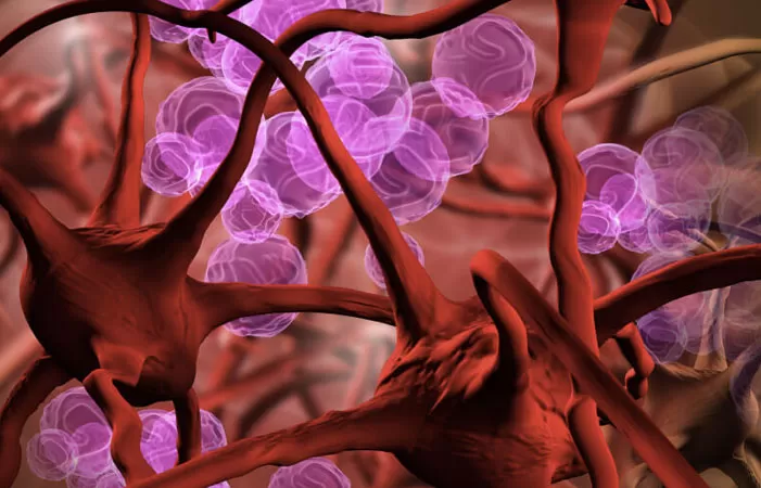 Anemia falciforme