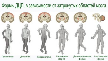 Paralisi cerebrale