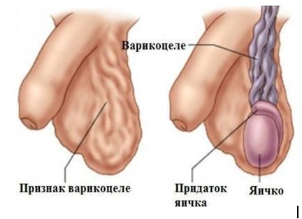 VARICOCELE